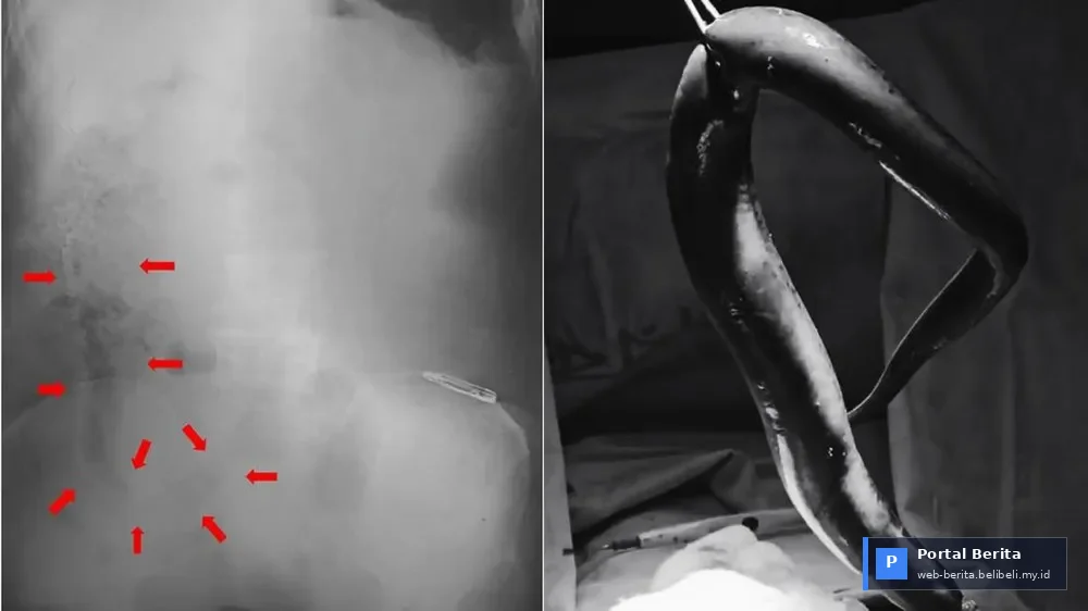Geger 2026: Belut Hidup Sepanjang 65 Cm Ditemukan di Usus Nelayan, Tim Dokter Terkejut!