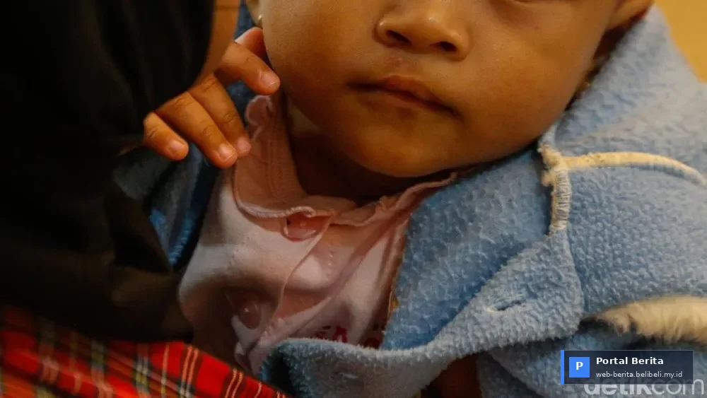 Senyum Harapan 2026: Operasi Bibir Sumbing Gratis di RS Hermina Bogor Ubah Hidup 17 Anak, Akses Kesehatan Merata Terwujud!